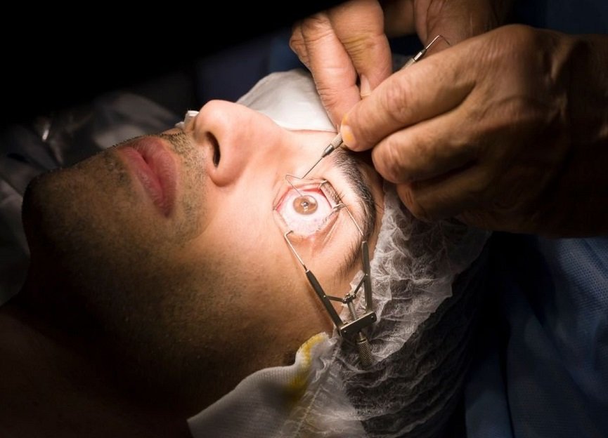 LASIK Surgery